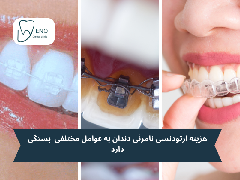 هزینه ارتودنسی نامرئی دندان