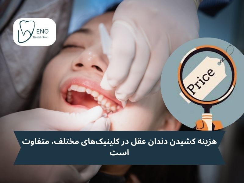 هزینه کشیدن دندان عقل