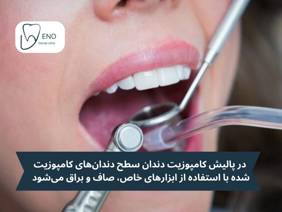 پالیش کامپوزیت دندان چیست؟