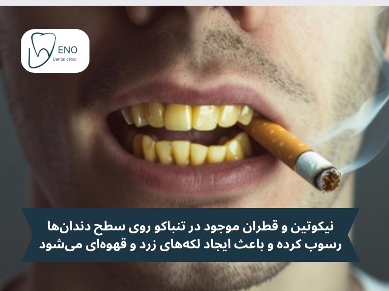 چرا دندانها زرد میشوند؟ بررسی عوامل تأثیرگذار