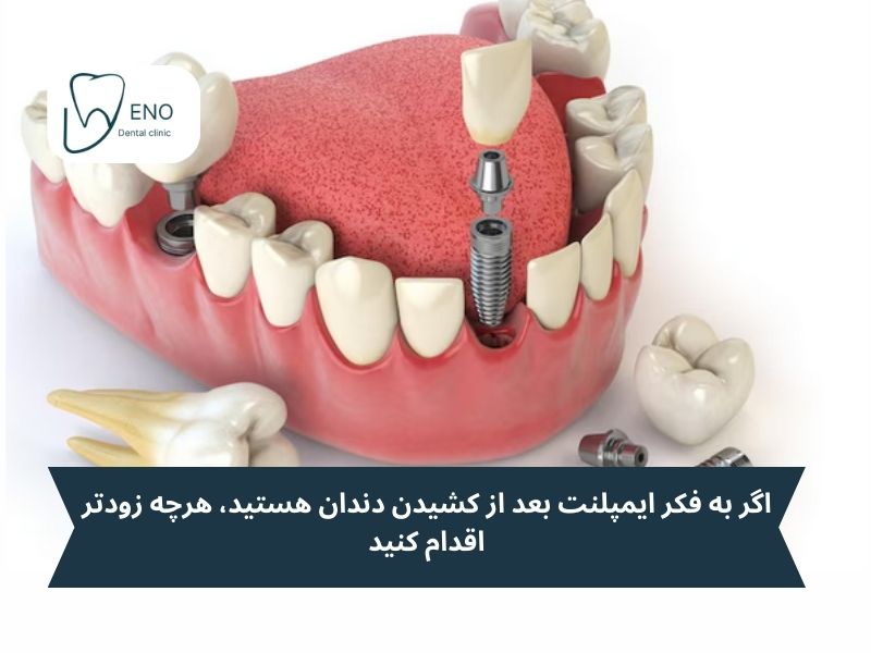 چه مدت بعد از کشیدن دندان باید ایمپلنت کرد