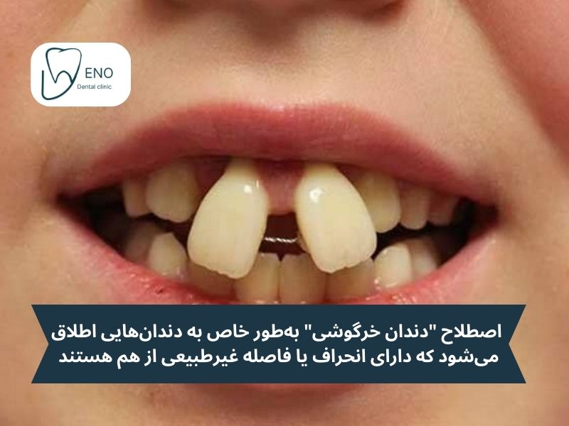 کامپوزیت دندان خرگوشی چیست