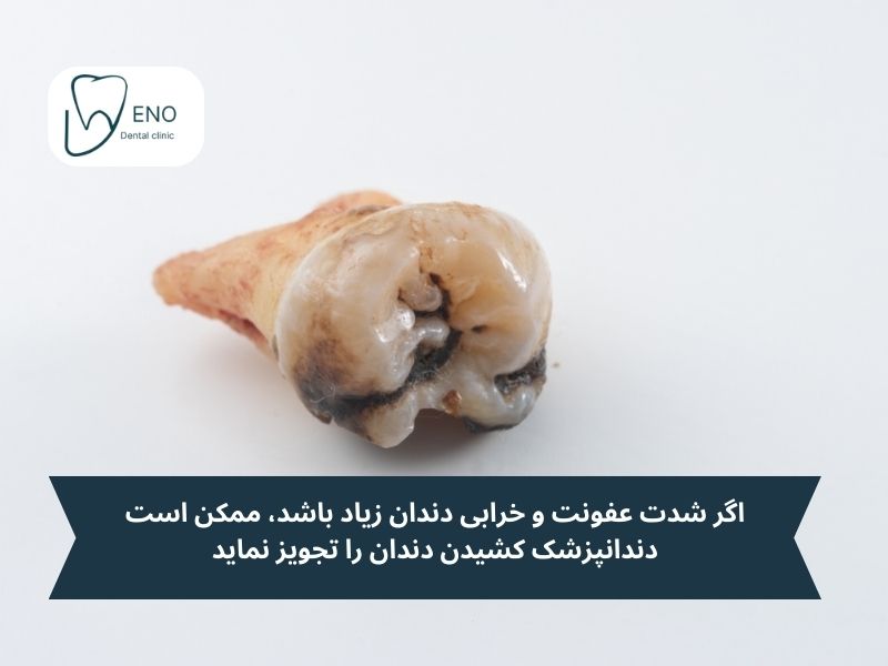 وقتی عصب کشی جواب ندهد، کشیدن دندان تنها راه حل است