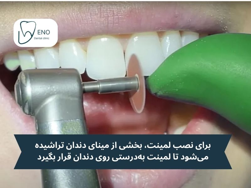 آماده سازی دندان؛ تراشیدن دندان در لمینت دندان یا کامپوزیت بیشتر است