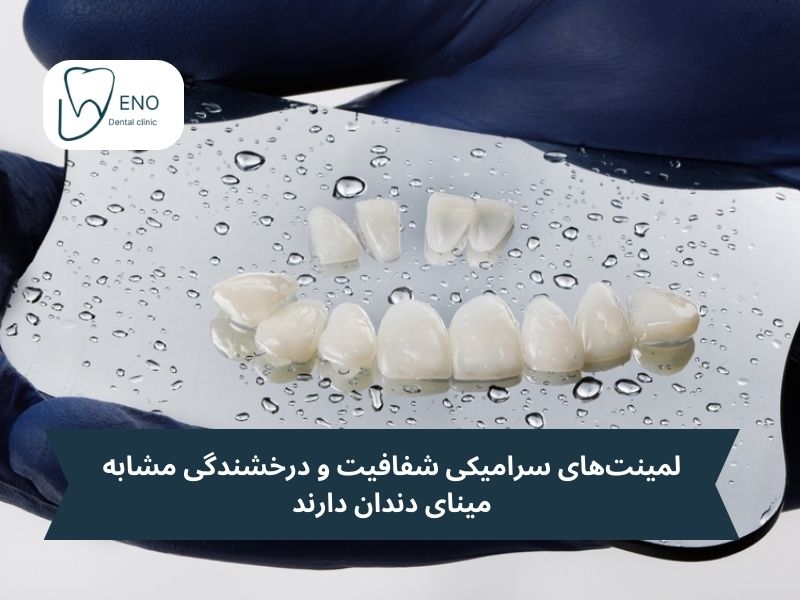 لمینت طبیعی تره یا کامپوزیت