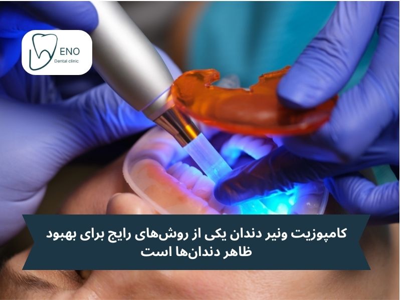 کامپوزیت ونیرهای دندانی