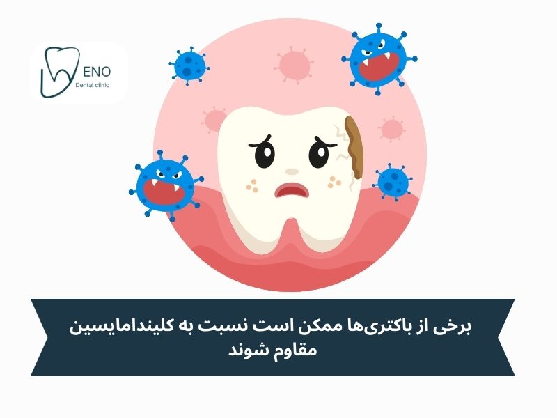 آیا کلیندامایسین برای عفونت دندان همیشه مؤثر است؟