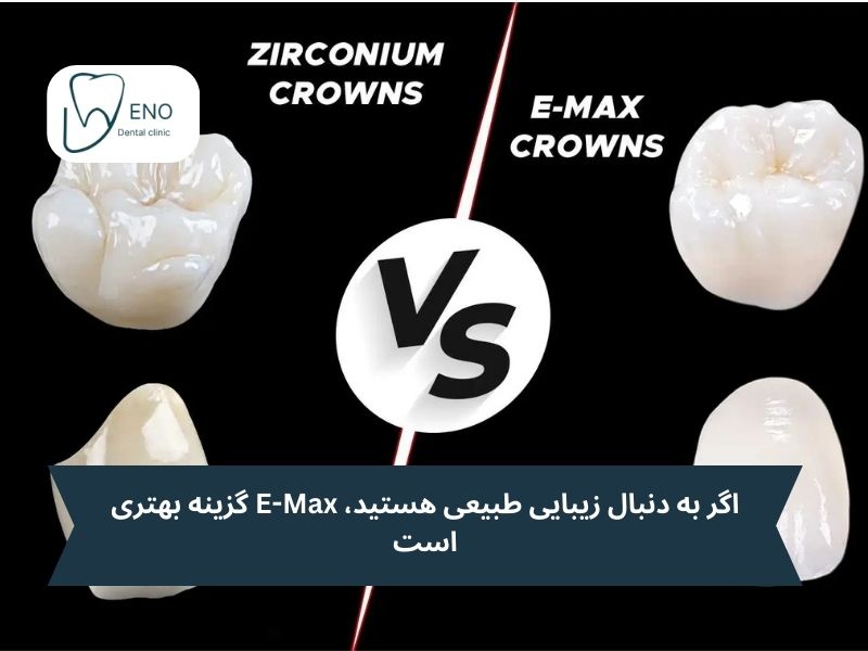 تفاوت ایمکس و زیرکونیا
