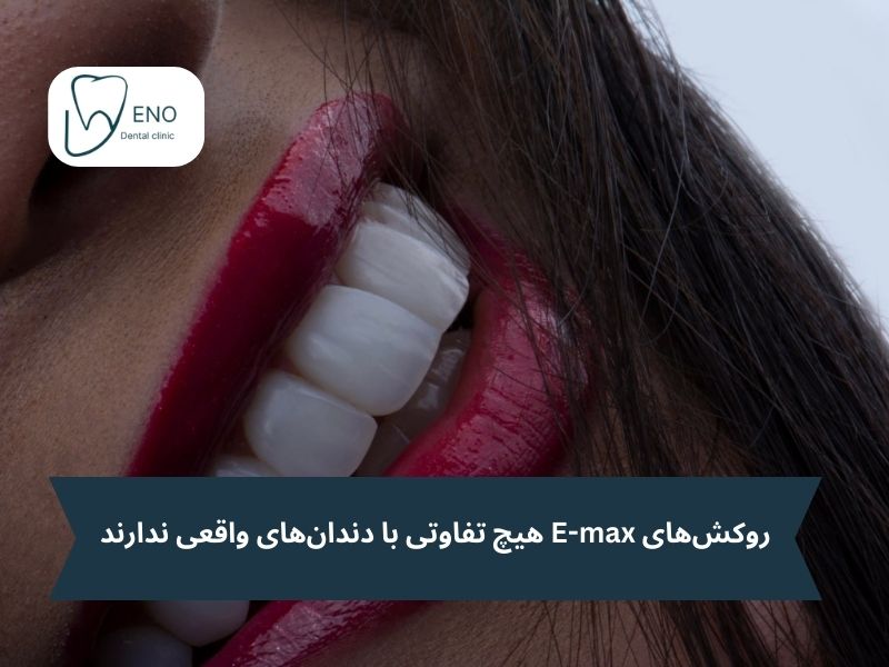 داشتن ظاهر طبیعی لمینت ایمکس