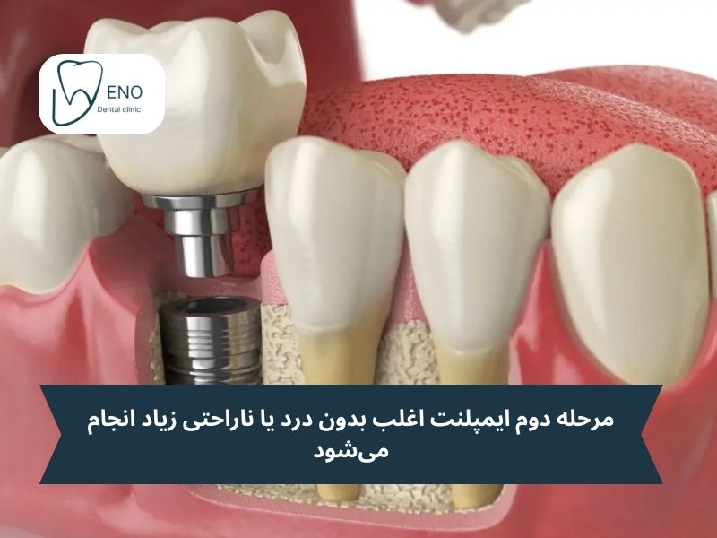 درد ایمپلنت دندان در کدام مرحله است؟
