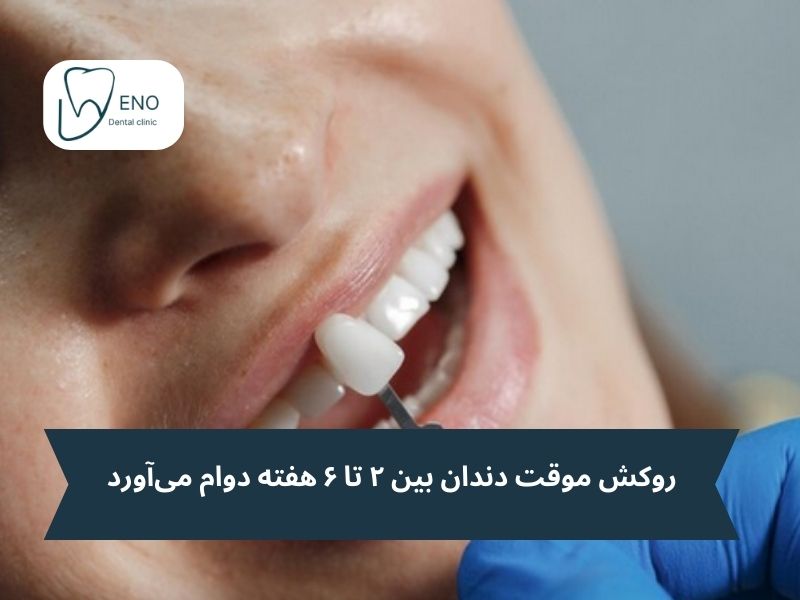روکش موقت دندان چقدر دوام دارد