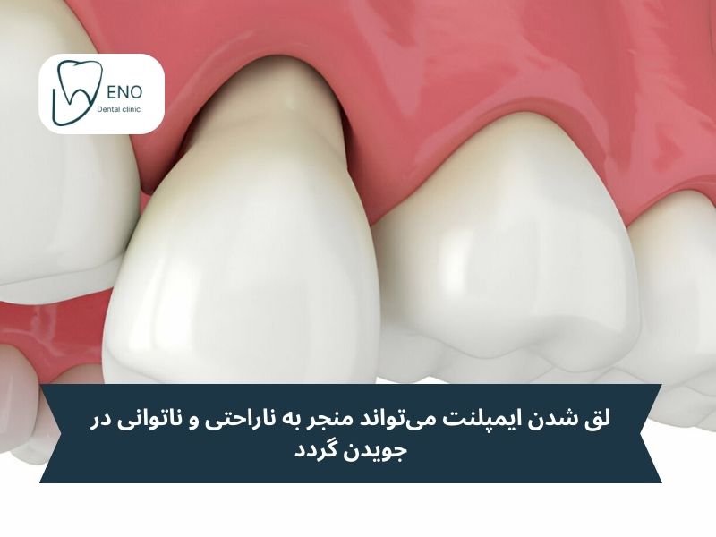 علت درد ایمپلنت دندان