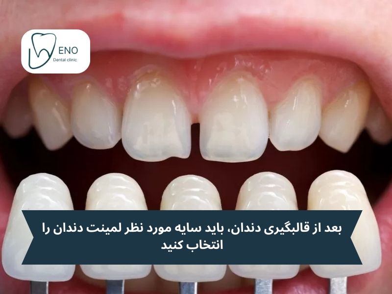 مراحل ایجاد لبخندی زیبا با لمینت ایمکس