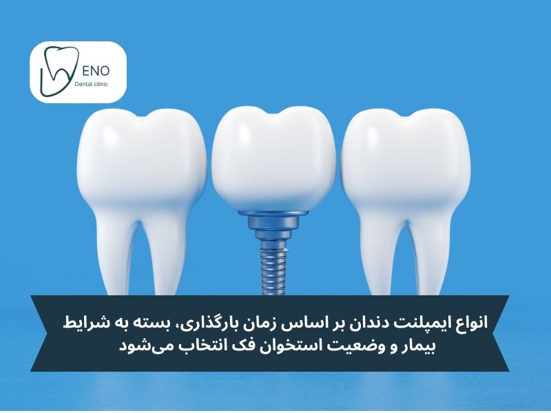 ایمپلنتها بر اساس زمان بارگذاری