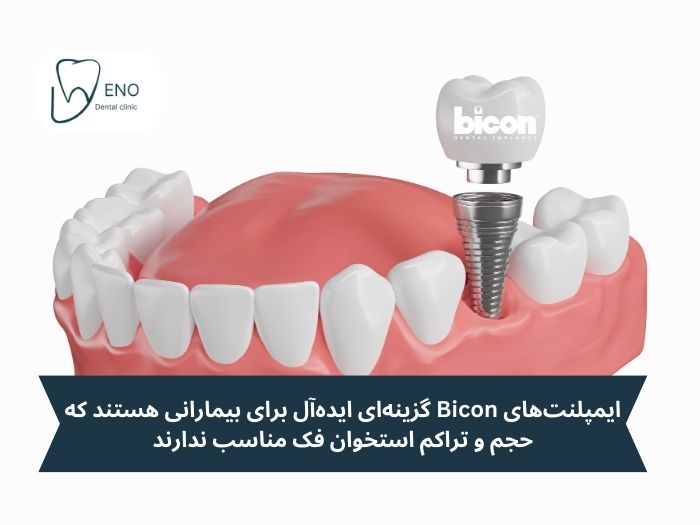 ایمپلنت بیکن؛ مناسب برای افراد دارای تراکم استخوان پایین