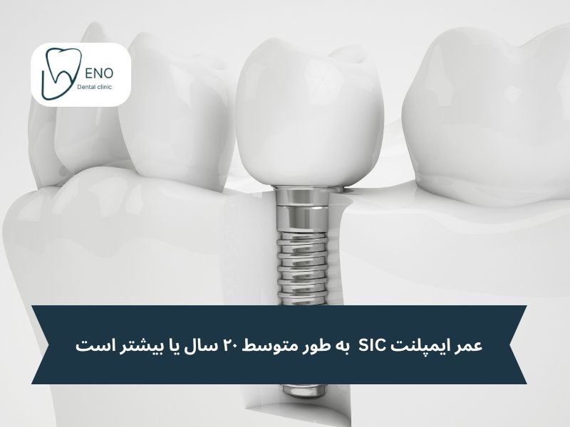 عمر ایمپلنت SIC