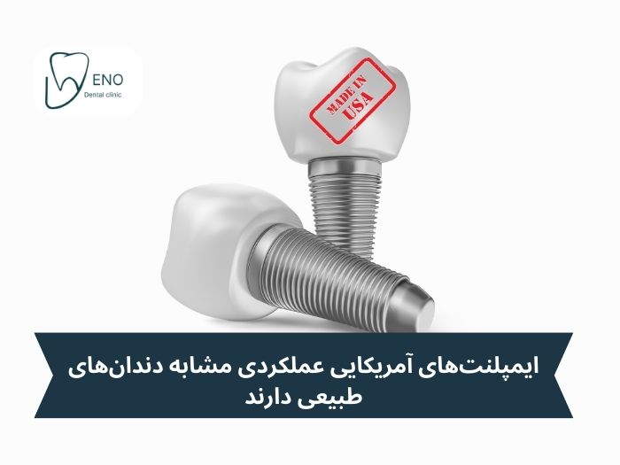 مزایای استفاده از ایمپلنت آمریکایی