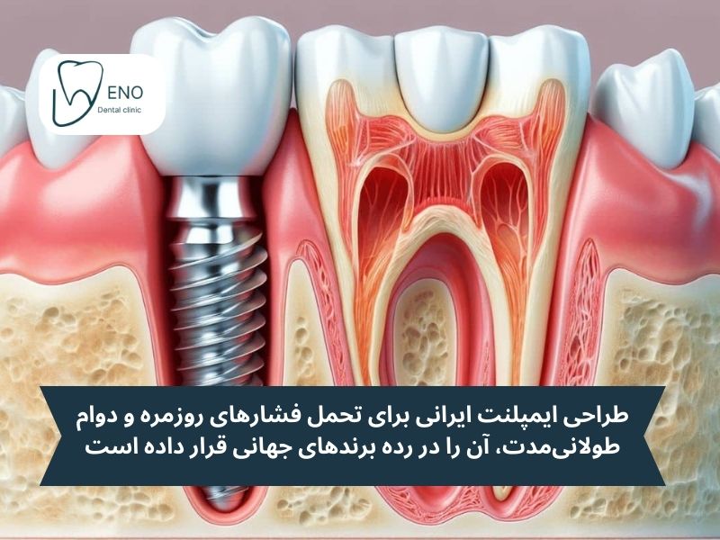 ویژگیهای طلایی ایمپلنت ایرانی