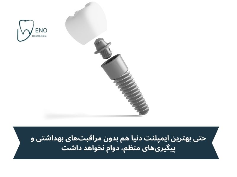 آیا ایمپلنت osstem در بلندمدت دوام دارد