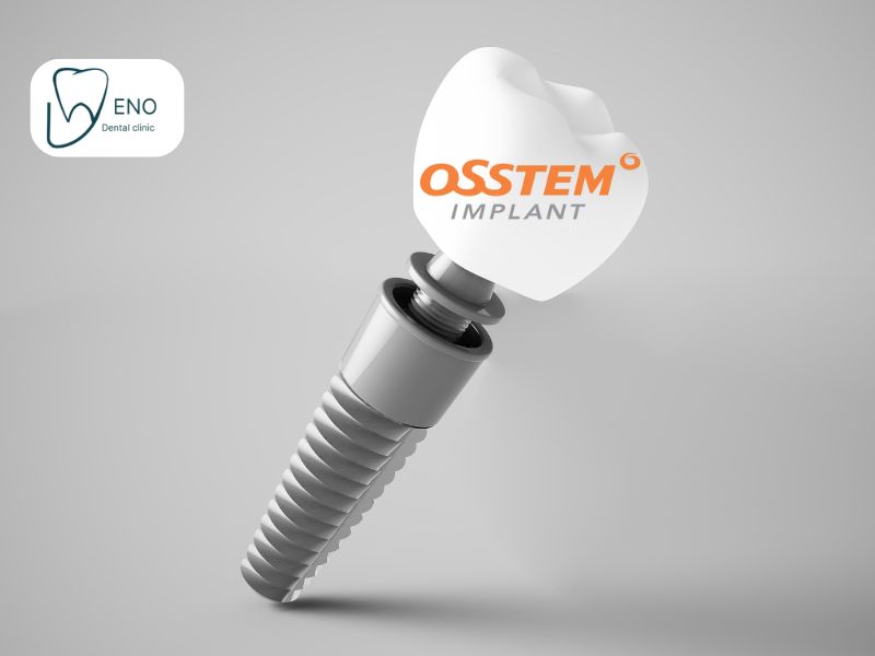 ایمپلنت osstem