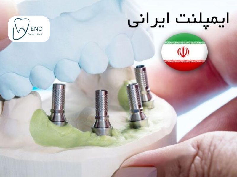 ایمپلنت ایرانی