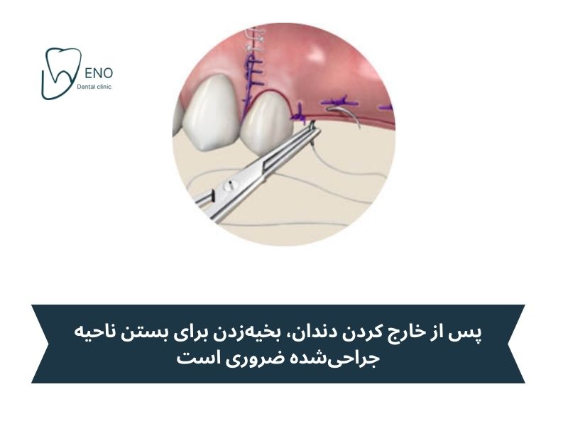بخیه زدن بعد از جراحی دندان عقل