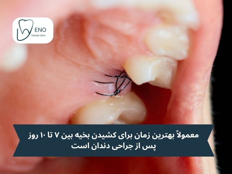 بهترین زمان کشیدن بخیه دندان