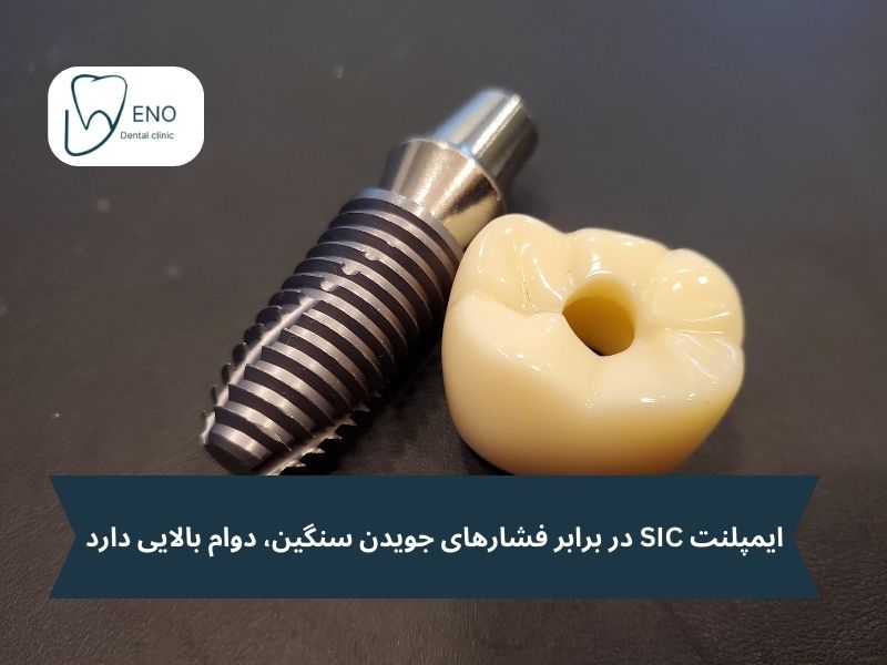 مزایای شگفت‌انگیز ایمپلنت SIC