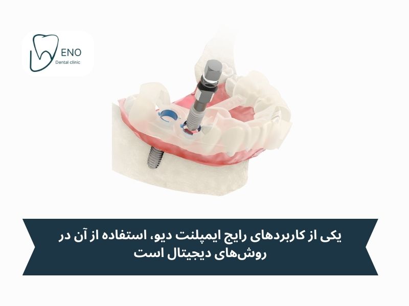 موارد استفاده رایج ایمپلنت dio