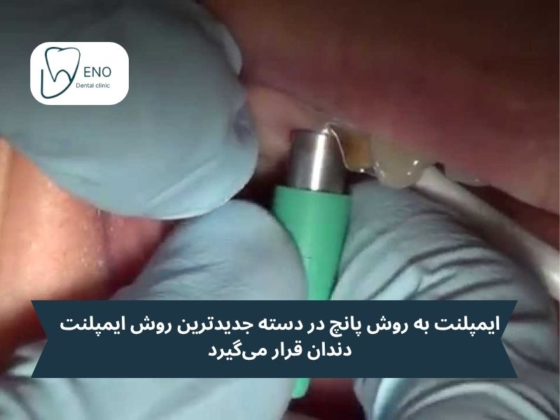ایمپلنت به روش پانچ
