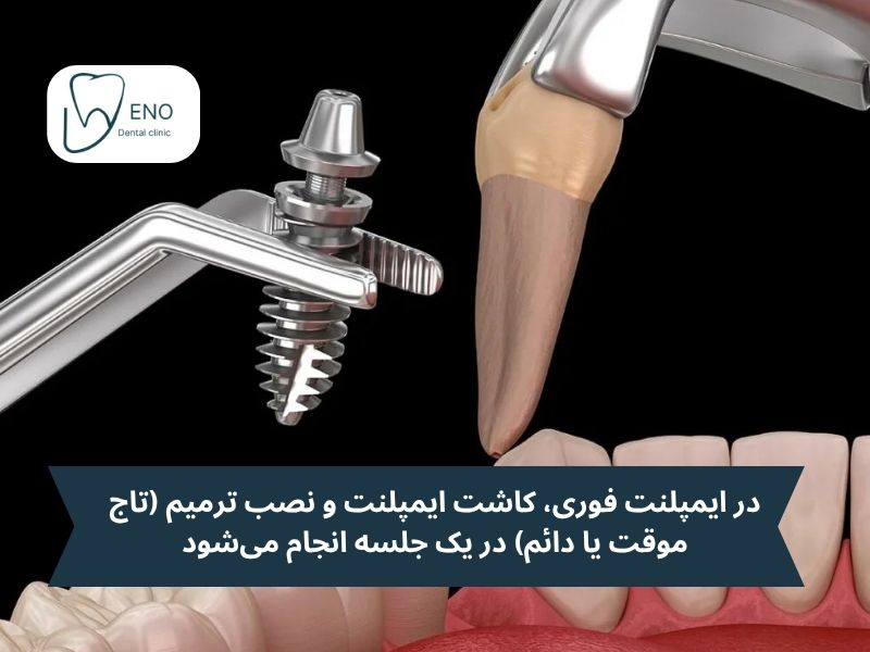 تحولی نو در جدیدترین روش ایمپلنت دندان