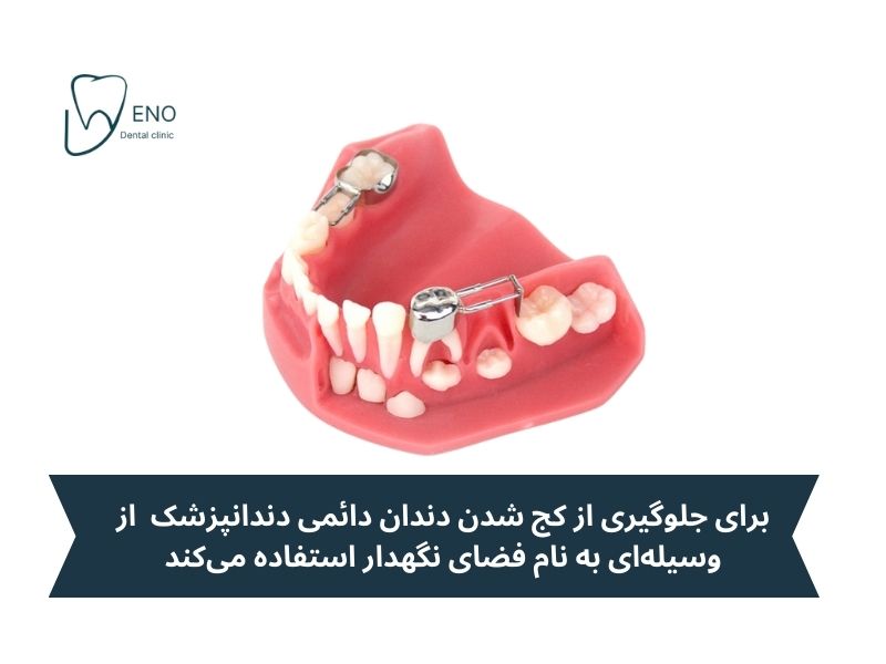 فضا نگهدار دندان کودک