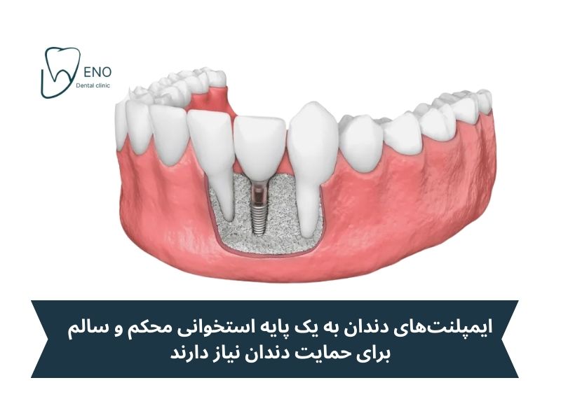 پیوند استخوان دندان برای ایمپلنت