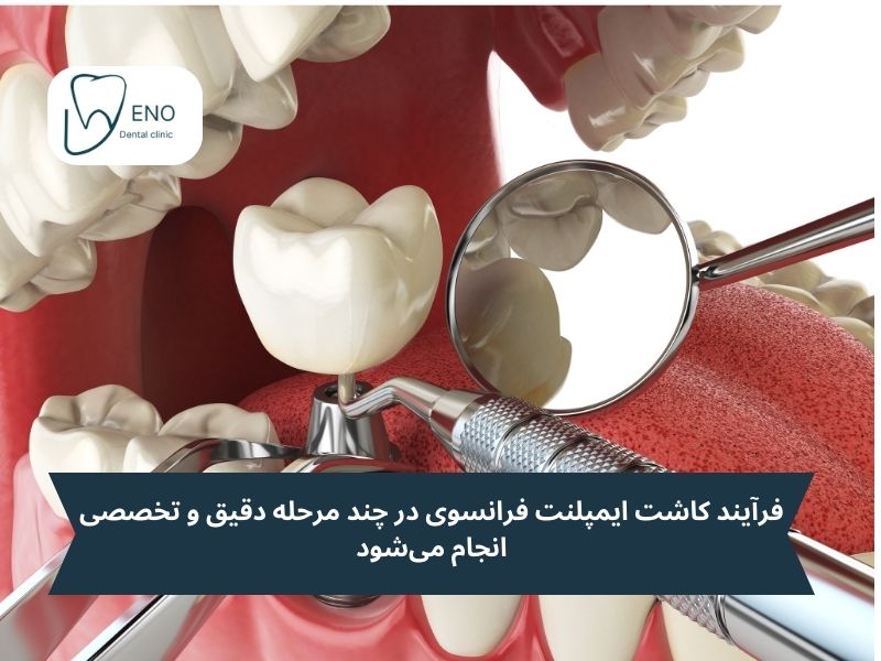 مراحل کاشت ایمپلنت فرانسوی