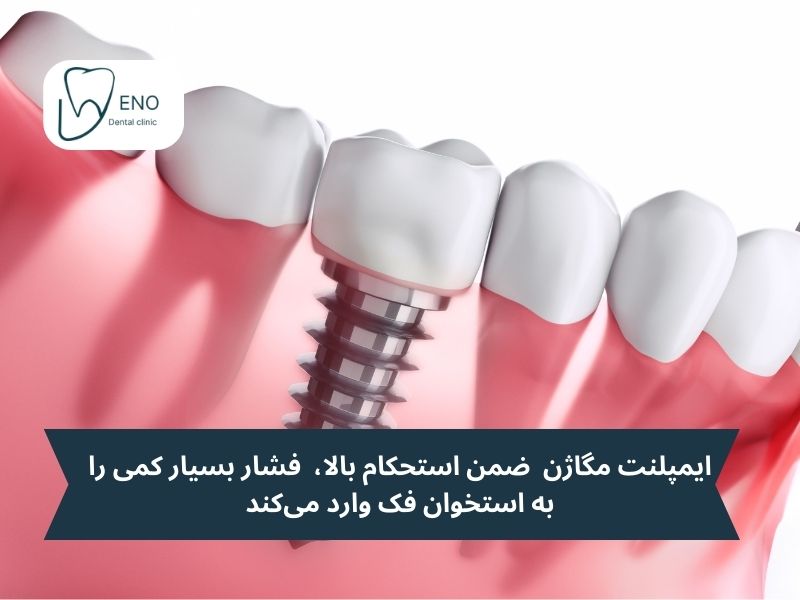 استحکام بالا ایمپلنت مگاژن