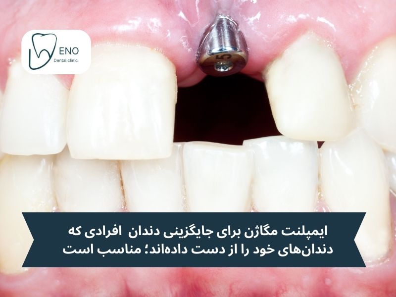 جایگزینی دندان