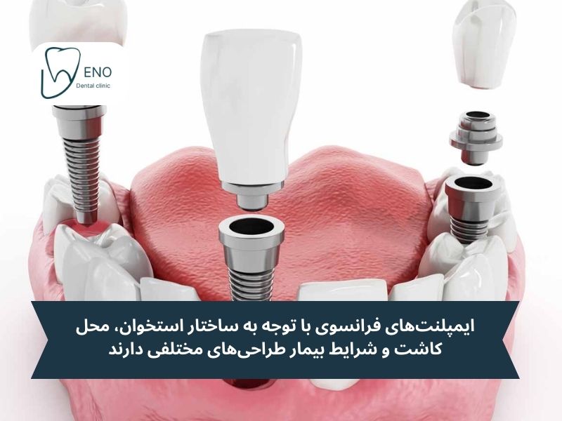 ایمپلنت‌های فرانسوی با توجه به ساختار استخوان، محل کاشت و شرایط بیمار طراحی‌های مختلفی دارند