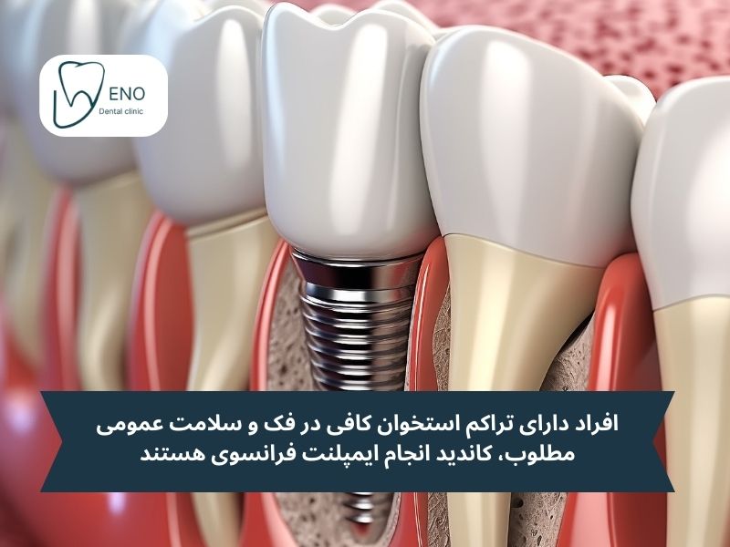 چه کسانی کاندید مناسبی برای استفاده از ایمپلنت فرانسوی هستند
