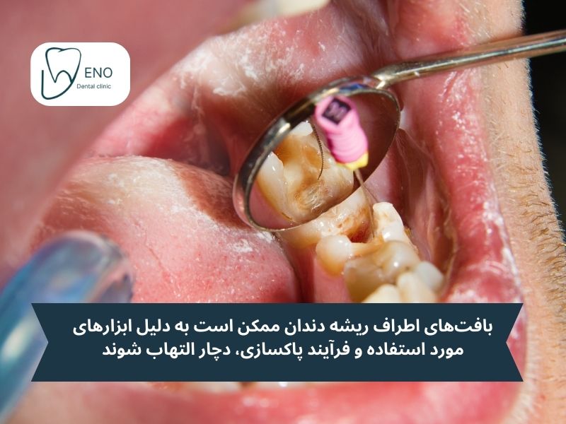 بافت‌های اطراف ریشه دندان (بافت‌های پری‌آپیکال Periapical Tissues) ممکن است به دلیل ابزارهای مورد استفاده و فرآیند پاکسازی، دچار التهاب شوند