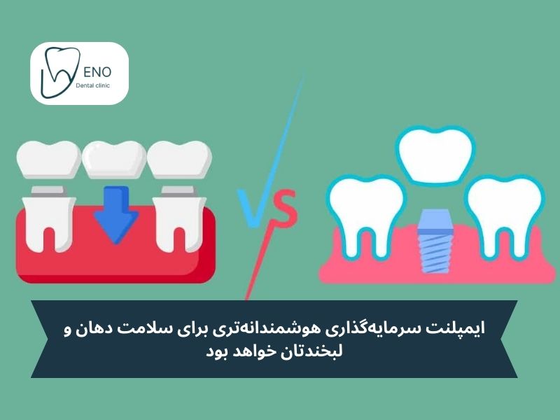 بررسی اقتصادی بریج یا ایمپلنت