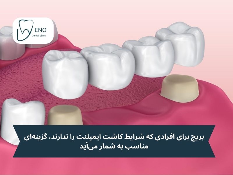 بریج دندان چیست
