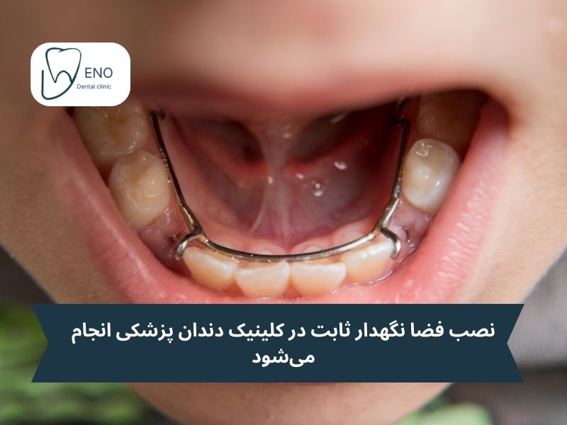 نصب فضا نگهدار ثابت