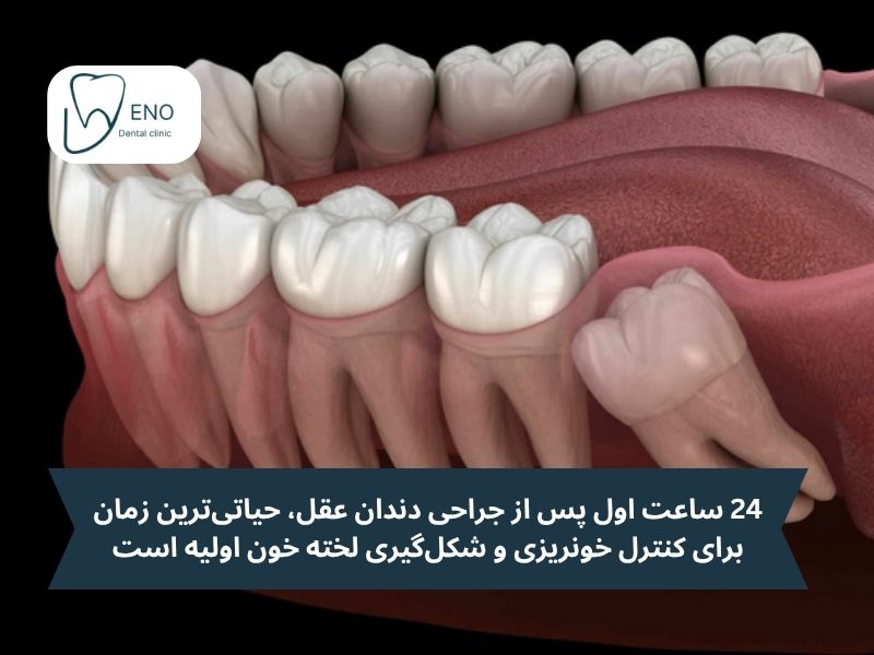 اولین و مهمترین گامها در مراقبت بعد از جراحی دندان عقل