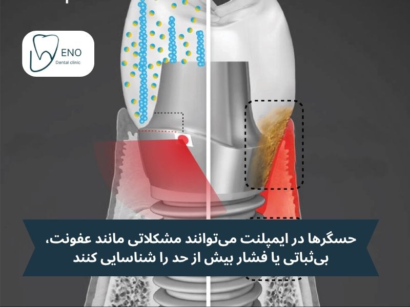 ایمپلنتهای هوشمند مجهز به حسگر