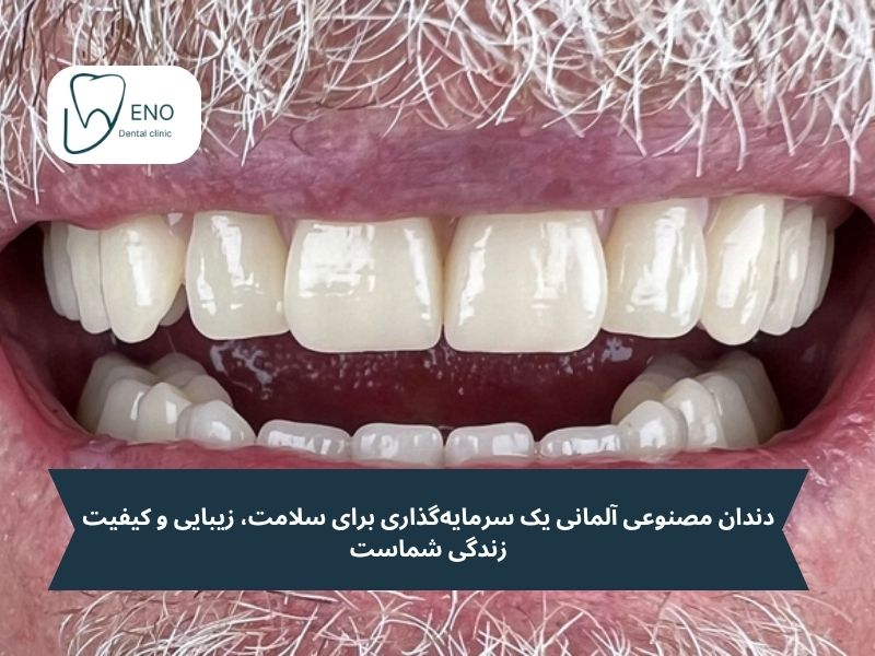 بررسی قیمت دندان مصنوعی آلمانی و عوامل موثر بر آن