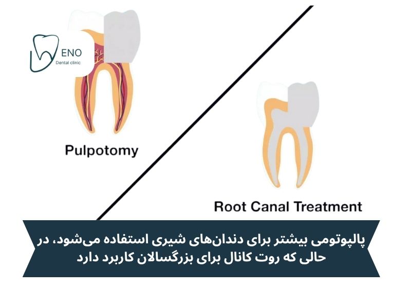 تفاوت پالپوتومی و روت کانال