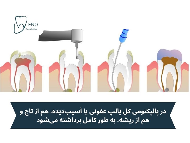 پالپکتومی چیست