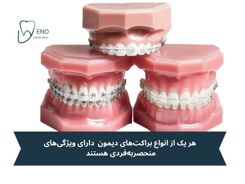 انواع براکتهای دیمون