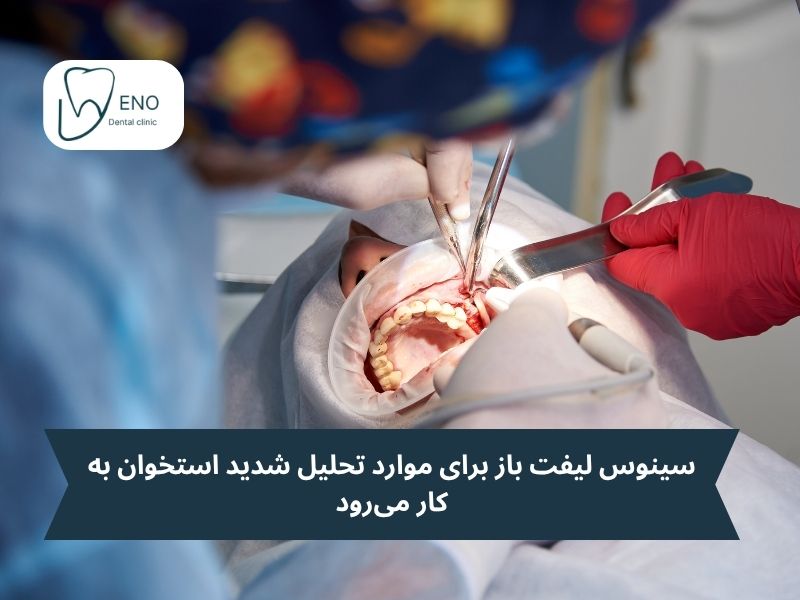 سینوس لیفت باز؛ روش لترال ویندوز -