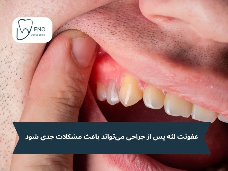 علائم عفونت لثه بعد از جراحی